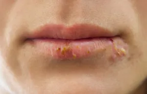 De foarte multe ori există un herpes pe buze - cauze