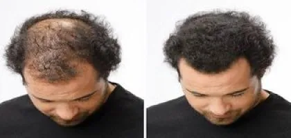 Описание коса сгъстяване на плешив лепенки caboki и съвети лекар
