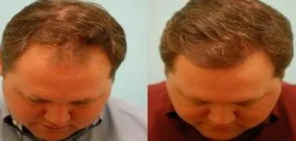 Описание коса сгъстяване на плешив лепенки caboki и съвети лекар