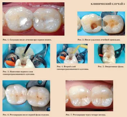 restaurări Despre compozit articole de medicina dentara moderna