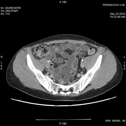 Опитът за използване на CT enterograph в диагностиката на болестта на Крон