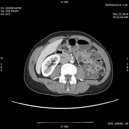 Опитът за използване на CT enterograph в диагностиката на болестта на Крон