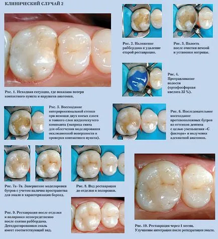 restaurări Despre compozit articole de medicina dentara moderna