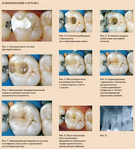 restaurări Despre compozit articole de medicina dentara moderna