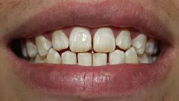 Fogfehérítés a fluorosis