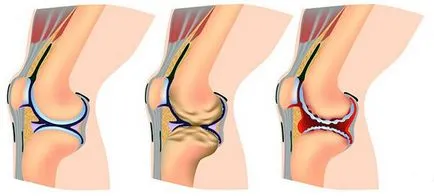 Остеоартрит на коляното причинява, симптоми, методи за лечение