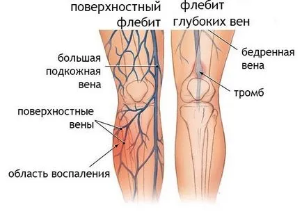 Подуването на крака под коляното и причините лечение