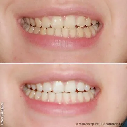 Fogfehérítő szalagok gerincén 3d fehér whitestrips Luxe szakmai hatások - «mosoly,