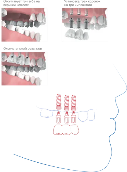 A betegek - MIS implantátum Oroszország i MIS implantátum