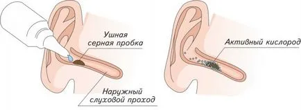 De ce cerumen apar în urechile unui copil și cum să eliminați în condiții de siguranță video