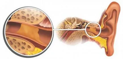Защо възникват ушна кал в ушите на детето и как да безопасно премахване на видеоклипа