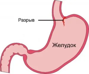 Причините и последствията от разкъсване на хранопровода, спонтанна руптура