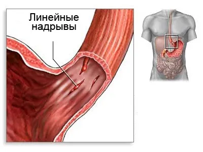 Okai és következményei a nyelőcső megrepedését, spontán törés