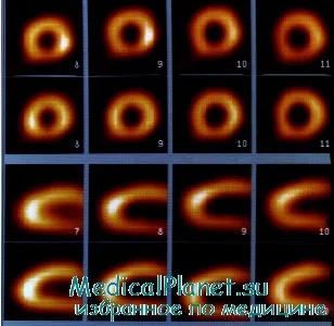 Радиоактивните методи за оценка на сърдечната функция