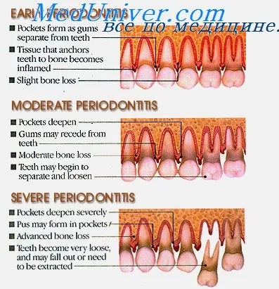Gyulladásgátló kezelést a periodontitis