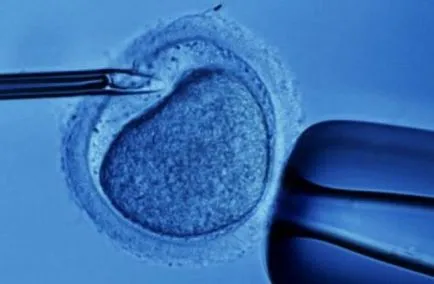 IVF - gyakran feltett kérdések