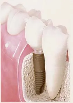 Restoration Dental tooth-Mogilev