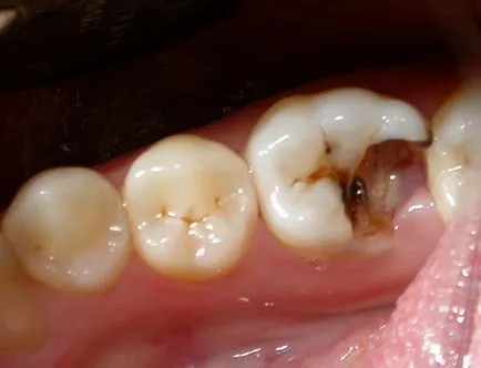 Restoration Dental tooth-Mogilev