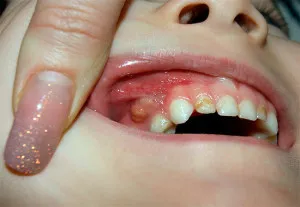Еднократно върху венците на детето - снимка абсцес какво да прави с абсцес