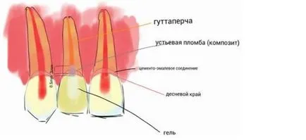 Грей плака върху зъбите причинява на лечението и профилактиката