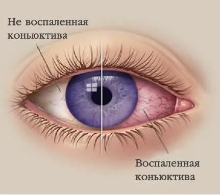 Сълзене на очите причини и лечения, при възрастни, деца, очите и зрението