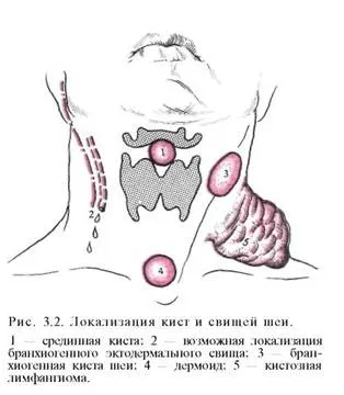 Медиана киста на симптомите врата, признаци, диагностиката и лечението