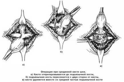 Медиана киста на симптомите врата, признаци, диагностиката и лечението