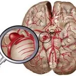 Striatal ангиопатия, като характеристика на мозъчния кръвоток