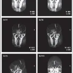 A corpus striatum angiopátia, mint a jellemzője, az agyi véráramlás