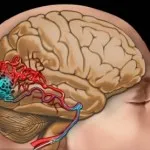 Striatal ангиопатия, като характеристика на мозъчния кръвоток