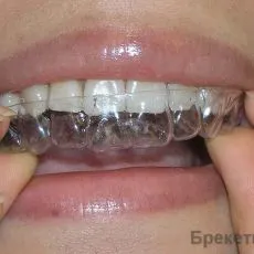 Costul alinierii dentare Mogilev