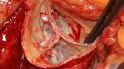 Tricuspid структура клапан и назначаването на