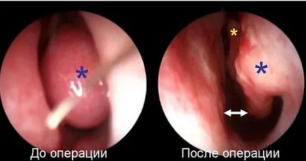 Vasotomy vazomotor rhinitis, lézeres vasotomy