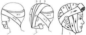 Видове медицински превръзки на главата му