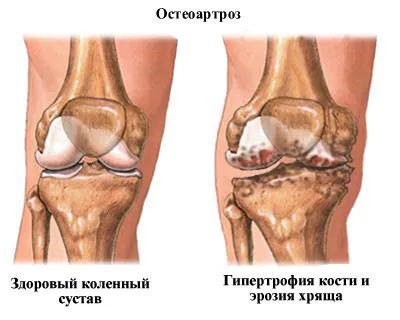 Възраст, свързани с промени в костите, мускулите, ставите, гръбнака