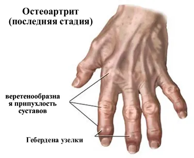 Възраст, свързани с промени в костите, мускулите, ставите, гръбнака