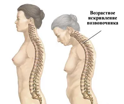 Възраст, свързани с промени в костите, мускулите, ставите, гръбнака