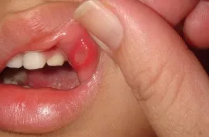 Ulcerație la nivelul gingiilor, cauzele educației, metode de tratament