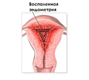 Krónikus endometritis és a terhesség, hogy ez a betegség, a kezelés, a tünetek és súlyosbodása