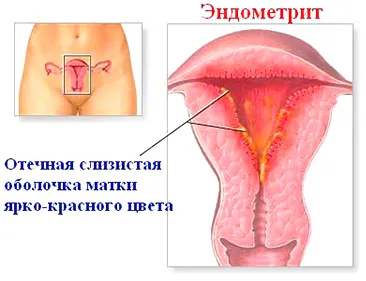 Krónikus endometritis és a terhesség, hogy ez a betegség, a kezelés, a tünetek és súlyosbodása