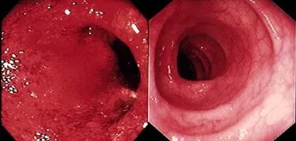 A fekélyes vastagbélgyulladás kezelése a bélférgek colitis, a fekélyes vastagbélgyulladás kezelésében a férgek