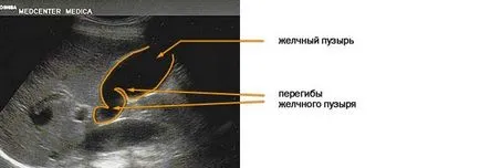 Curbura a vezicii biliare
