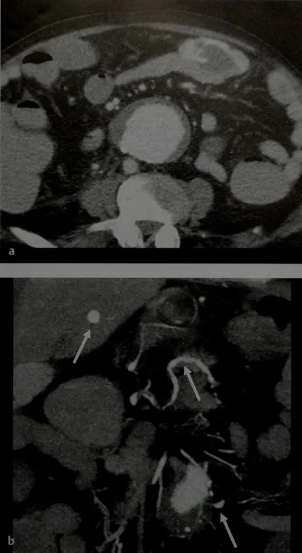 sângerări gastro intestinale