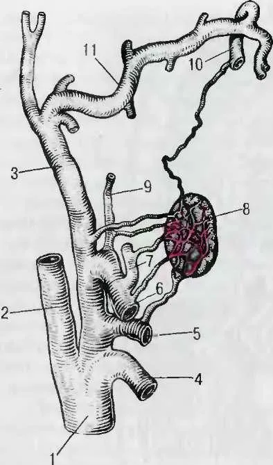 1 - 2 Shaped sine epiglottis; 3 - cherpaloiadgortannye raktár-ki