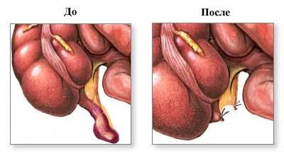 Cauze Apendicita, simptome, diagnostic și tratament