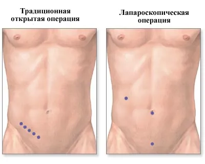 Cauze Apendicita, simptome, diagnostic și tratament