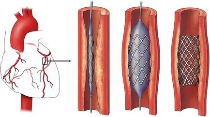 Atherosclerosis a szívkoszorúerek - azaz, a tünetek és a kezelés