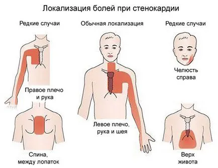 Atherosclerosis a szívkoszorúerek - azaz, a tünetek és a kezelés