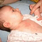 Бели и червени пъпки по лицето на новороденото - как да се отървем от бързо премахване на причините и лечението