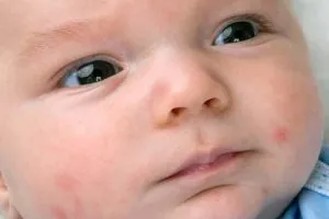Бели и червени пъпки по лицето на новороденото - как да се отървем от бързо премахване на причините и лечението